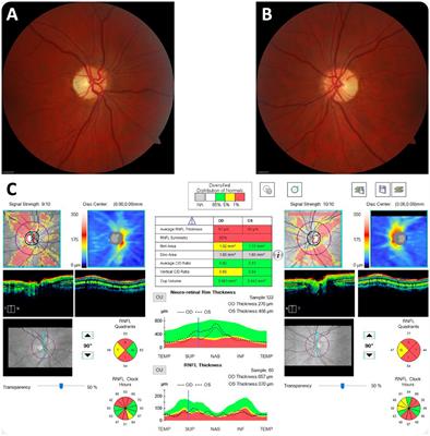 Case report: Mutations in DNAJC30 causing autosomal recessive Leber hereditary optic neuropathy are common amongst Eastern European individuals